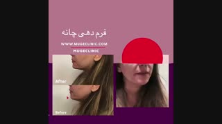 فرم دهی چانه بدون جراحی