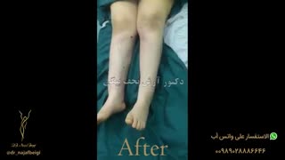 ازالة الدهون من الساقین