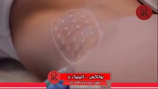 تزریق بوتاکس | فیلم تزریق بوتاکس | کلینیک پوست و مو رز | شماره 29
