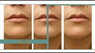 فیلم تزریق فیلر به لب