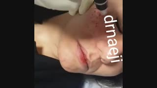 میکرونیدلینگ صورت در مطب دکتر صدیقه نائیجی متخصص پوست