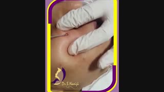 درمان جای آبله مرغان با ساب سیژن