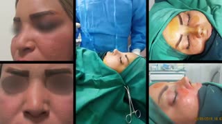 نمونه جراحی زیباییی بینی با کمک غضروف دنده
