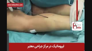 لیپوماتیک | فیلم لیپوماتیک | کلینیک پوست و مو هلیا | شماره 23