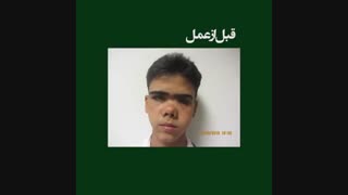 جراحی شکستگی بینی در کرمان آکنه
