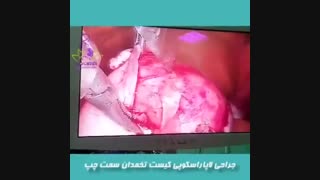 جراحی لاپاراسکوپی کیست تخمدان