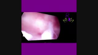 هیستروسکوپی و برداشتن پولیپ رحم توسط دکتر نصرت نقاب برداشتن خال گوشتی