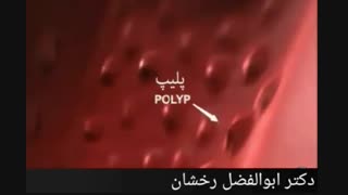 علل ابتلا به سرطان روده