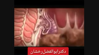 هموروئید چیست و چگونه درمان می شود؟