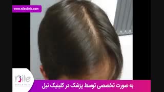کاشت مو | فیلم کاشت مو | کلینیک پوست و مو نیل | شماره 23