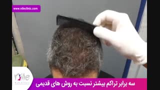 کاشت مو | فیلم کاشت مو | کلینیک پوست و مو نیل | شماره 25