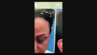 جراحی بینی ثانویه