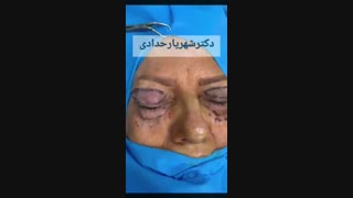 جراحی پلک در خانم 67 ساله