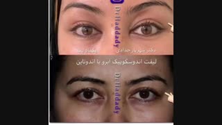 لیفت اندوسکوپیک ابرو با اندوتاین