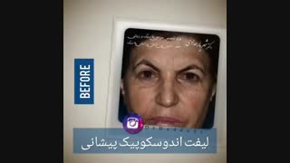 لیفت اندوسکوپیک پیشانی