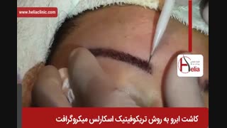 کاشت ابرو | فیلم کاشت ابرو | کلینیک پوست و مو هلیا | شماره 24