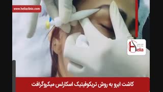 کاشت ابرو | فیلم کاشت ابرو | کلینیک پوست و مو هلیا | شماره 26
