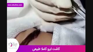 کاشت ابرو | فیلم کاشت ابرو | کلینیک پوست و مو نیل | شماره 26