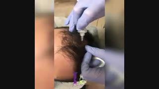 فیلم کربوکسی تراپی مو تزریق چربی