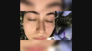 فیلم برداشت ضایعه پلک با لیزر ترمیم سوختگی