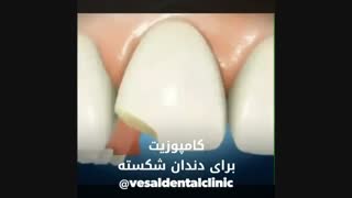 کامپوزیت دندان شکسته