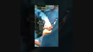عمل تعویض مفصل زانو