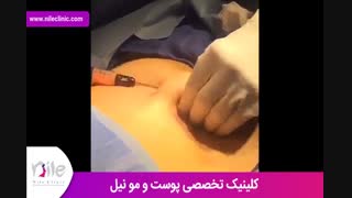 تزریق چربی | فیلم تزریق چربی | کلینیک پوست و مو نیل | شماره 19