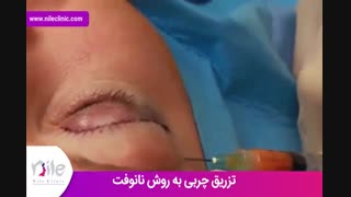 تزریق چربی | فیلم تزریق چربی | کلینیک پوست و مو نیل | شماره 21
