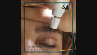 فیلم جراحی پلک