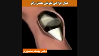 تعویض مفصل زانو