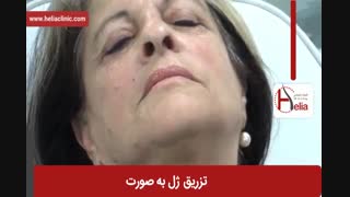 تزریق ژل | فیلم تزریق ژل | کلینیک پوست و مو هلیا | شماره 26
