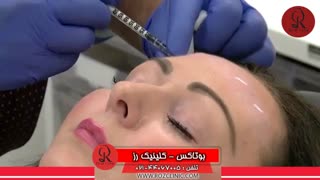 تزریق بوتاکس | فیلم تزریق بوتاکس | کلینیک پوست و مو رز | شماره 31
