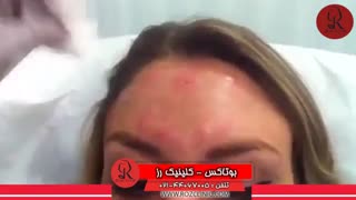 تزریق بوتاکس | فیلم تزریق بوتاکس | کلینیک پوست و مو رز | شماره 32