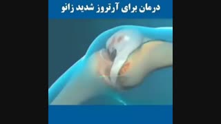 درمان ارتروز شدید زانو