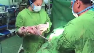زایمان سزارین توسط دکتر بنفشه قریشی زیبایی پوست