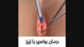 درمان بواسیر با لیزر لیفت گردنایمپلنت دندان