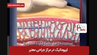 لیپوماتیک | فیلم لیپوماتیک | کلینیک پوست و مو هلیا 24