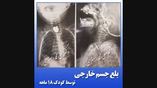 بلع جسم خارجی توسط کودک 18 ماهه