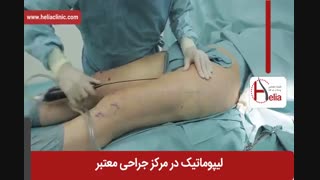 لیپوماتیک | فیلم لیپوماتیک | کلینیک پوست و مو هلیا 27