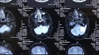 عفونت های گوش را باید جدی بگیریم