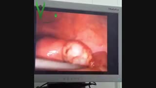 جراحی لاپاراسکوپی کیست تخمدان توسط دکتر فرجاد لرستانی