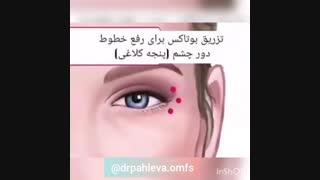 درمان پیری با تزریق بوتاکس عصب‌کشی