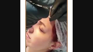 تزریق بوتاکس و رفع خط اخم