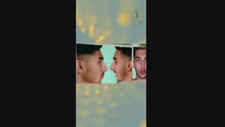 فیلم عمل بینی بلافاصله بعد از جراحی