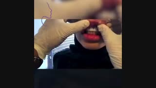 تخلیه ژل لب