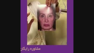 جراحی بینی ثانویه