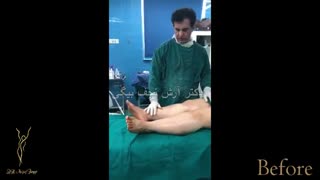 لیپوماتیک ساق پا
