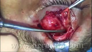 خارج کردن تومور کاسه چشم با بی حسی موضعی