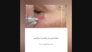 جوانسازی دور چشم با مزوتراپی