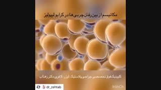لاغری با لیزر کرایولیپولیز توسط دکتر همایون زهتاب فوق تخصص جراحی پلاستیک جراحی گوش